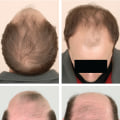 Natural Remedies for Male Pattern Baldness