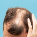 Understanding Hereditary Hair Loss