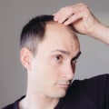 Lifestyle Changes for Preventing Male Pattern Baldness