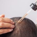 Understanding Minoxidil: A Comprehensive Guide to Treating and Preventing Hair Loss