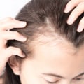 Diagnosing Female Hair Loss: Understanding the Causes and Treatment Options