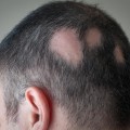 Understanding Alopecia: Causes, Treatments, and Prevention