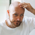 Understanding Male Pattern Baldness: Lifestyle Factors and Prevention