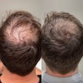 Exercise for Hair Health: Tips and Techniques to Regrow and Prevent Hair Loss