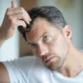 Understanding Hormonal Changes and Male Pattern Baldness