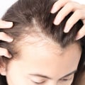 Understanding Female Hair Loss: Causes, Risk Factors, and Treatment Options