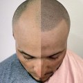 Understanding Hair Transplants and How to Prevent Hair Loss