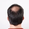 The Most Effective Medical Treatments for Male Pattern Baldness