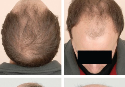 Natural Remedies for Male Pattern Baldness