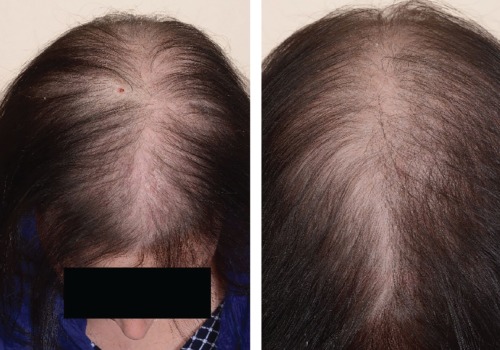 Female Pattern Hair Loss: Understanding the Causes and Finding Solutions