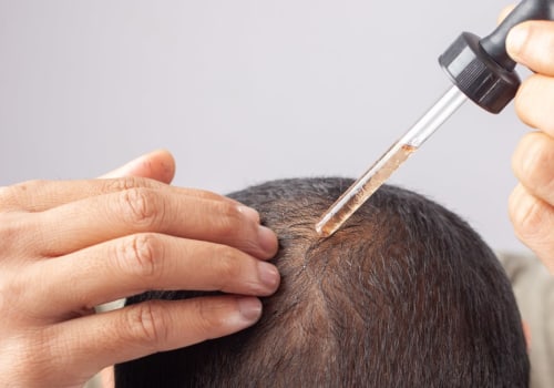 Understanding Minoxidil: A Comprehensive Guide to Treating and Preventing Hair Loss