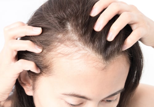 Diagnosing Female Hair Loss: Understanding the Causes and Treatment Options