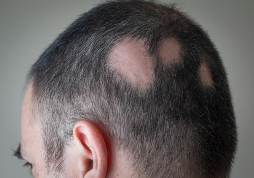 Understanding Alopecia: Causes, Treatments, and Prevention