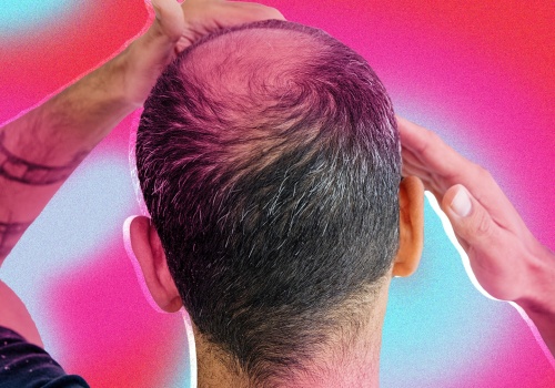 Hairstyles for Thinning Hair: Tips and Tricks to Prevent and Manage Male Pattern Baldness