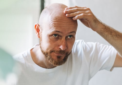 Understanding Male Pattern Baldness: Lifestyle Factors and Prevention