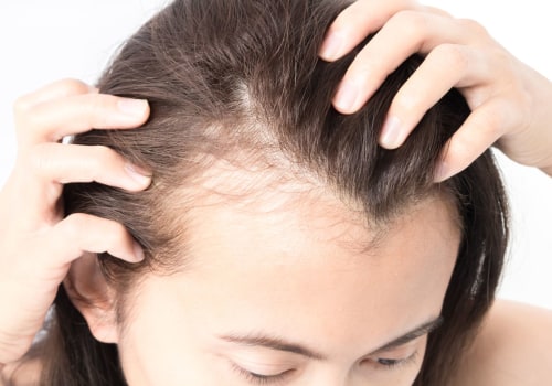 Understanding Female Hair Loss: Causes, Risk Factors, and Treatment Options