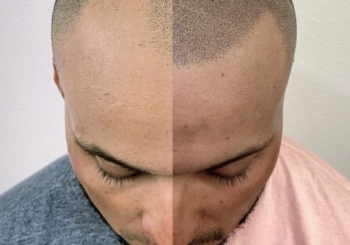 Understanding Hair Transplants and How to Prevent Hair Loss