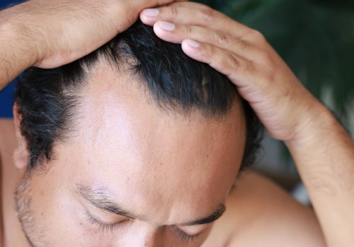 Understanding Finasteride: The Ultimate Guide to Preventing Hair Loss