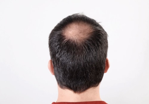 The Most Effective Medical Treatments for Male Pattern Baldness